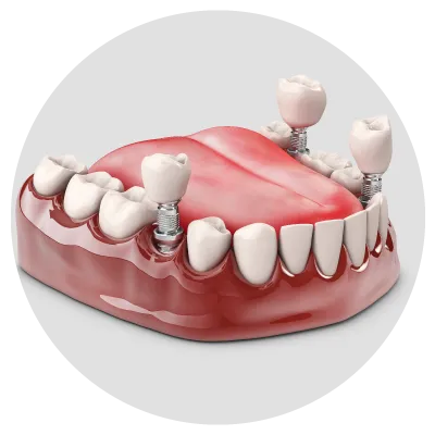 Dental implant Affordable Dental implant procedure at Putramahkota Dental Clinic in Bandar Mahkota Cheras