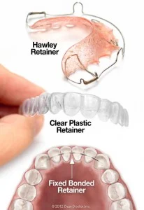 types of retainer Side-by-side comparison of clear plastic retainer and traditional wire retainer for teeth alignment retention